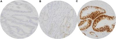 Potential predictors for CDX2 expression loss and mismatch repair deficiency in colorectal cancer
